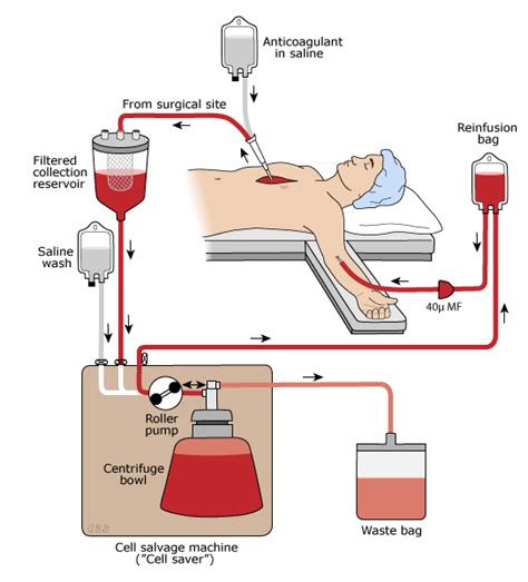 What is Autotransfusion? – Safe Blood