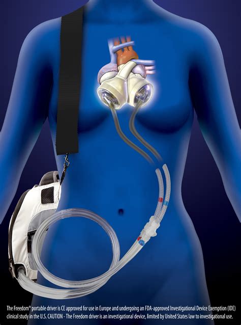 SynCardia Total Artificial Heart Surpasses 100th Implant of 2013