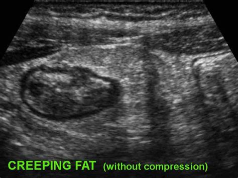 The Radiology Assistant : Crohn's disease - role of Ultrasound