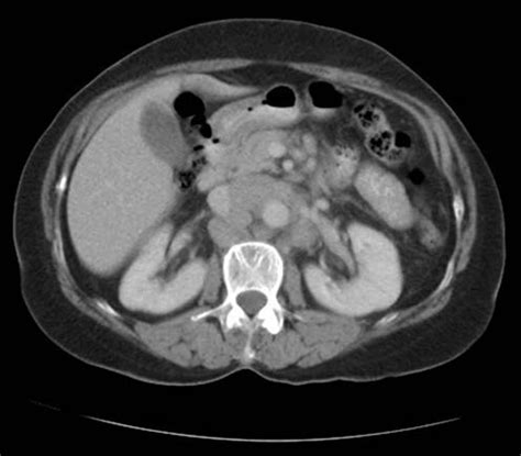 CT scan showing enlarged para-aortic lymph nodes | Download Scientific ...