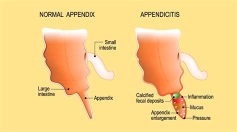 Ace Info About How To Tell If Your Appendix Hurts - Blockbath71