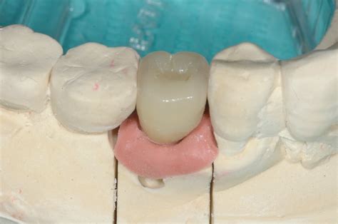 A Periodontal Expert: Astra® Dental Implant System