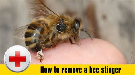 How To Get Rid Of Bee Stings - Crazyscreen21