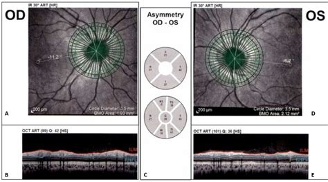 Laser tomography. (A) Right eye circle scan. (B) Right OCT scan with... | Download Scientific ...