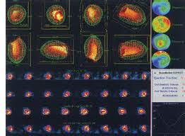 what is a MUGA scan, what is Multi Gated Acquisition Scan, hemonc101