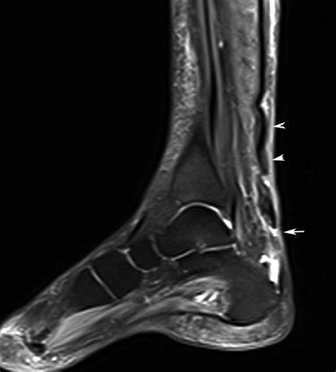 Radiodiagnosis - Imaging is Amazing-Interesting cases: Achilles tendon rupture - MRI