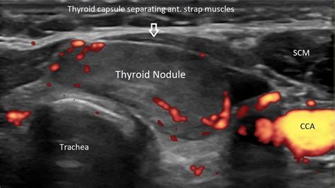 Radiofrequency Ablation Offers a Nonsurgical Treatment for Thyroid ...