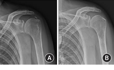 Figure 1 from Clinical and radiological outcomes of ultrasound-guided barbotage using a spinal ...