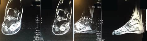 A Closer Look At Drilling And Cartilage Replacement For Talar Dome Lesions