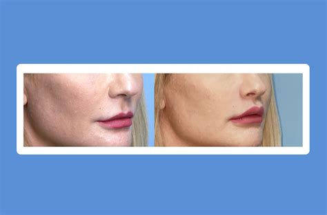 Lip Lift Surgery- What Should You Know Before A Lip Lift Surgery?