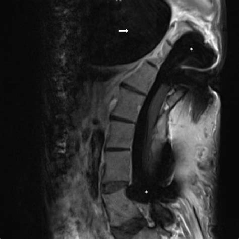 Postoperative axial MRI demonstrates stable left thoracic giant... | Download Scientific Diagram