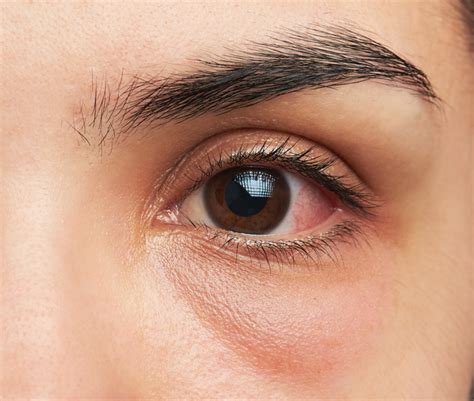 What May Cause Eyelid Swelling - Eye Institute of Houston