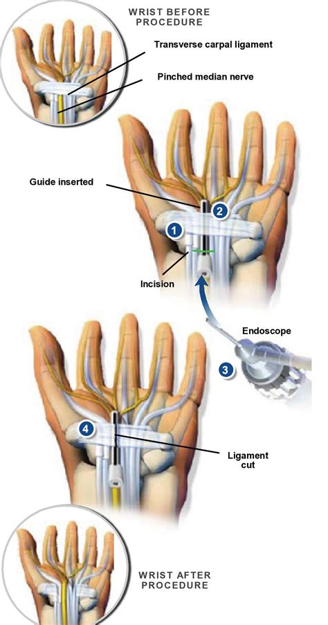 Endoscopic Carpal Tunnel Release