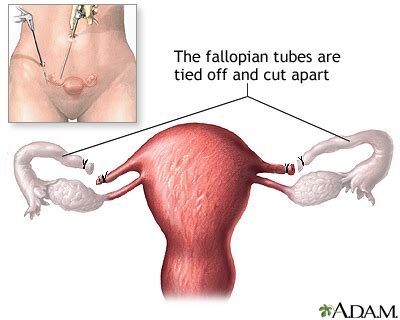 Tubal Ligation Diagram