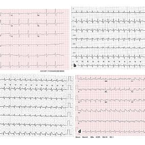 a Electrocardiogram on admission showing normal sinus rhythm. b ...