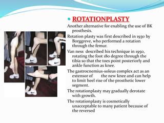 PFFD [proximal femoral focal deficiency] | PPT