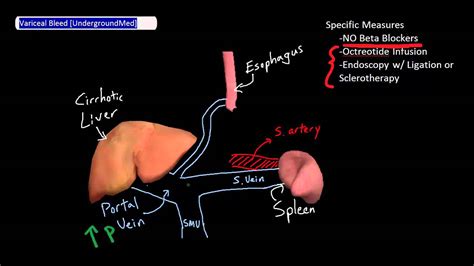 Variceal Bleed Management [UndergroundMed] - YouTube