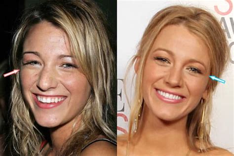 Did Blake Lively Have Plastic Surgery? (Before & After 2022)