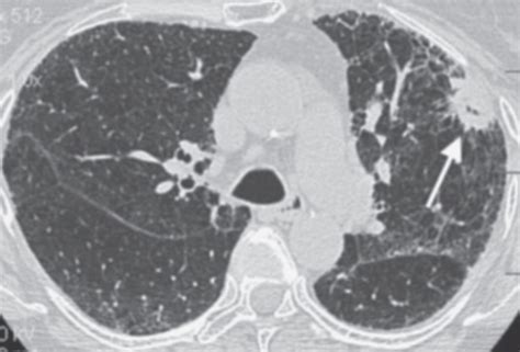 Solitary and Multiple Pulmonary Nodules | Radiology Key