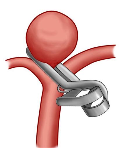 Dr. Arun L.Naik - Aneurysm Clipping