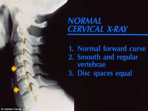 Text neck seen in shocking X-rays of teenagers | Daily Mail Online