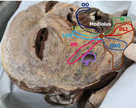 Buccinator Cadaver