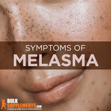 Melasma: Symptoms, Causes & Treatment