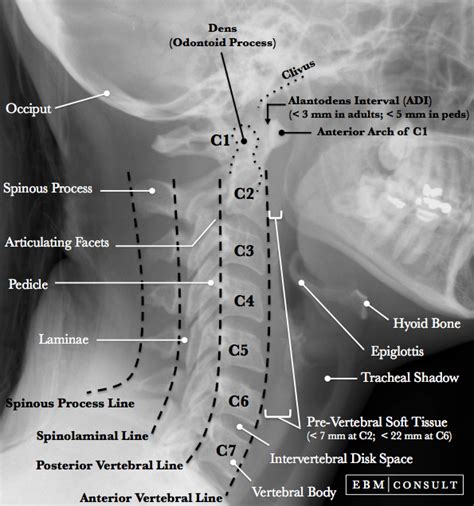 C1 Vertebral (Jefferson) Fractures - General Review