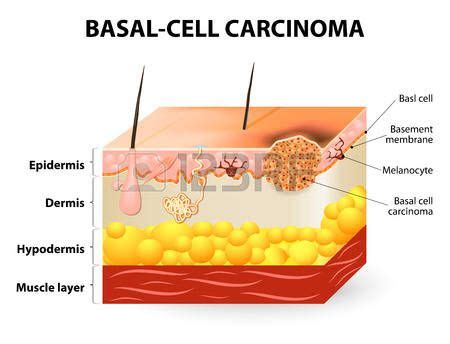 cáncer de piel. El carcinoma de células basales o el cáncer de células ...