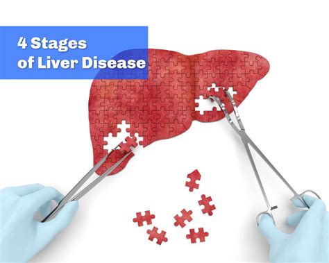 What Are The Four Stages Of Liver Disease? - Walkin Lab