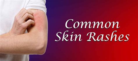 Skin Rashes: Types, Causes, Diagnosis, Treatment - Skin Care | MedPlusMart