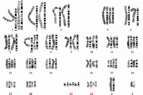 A karyogram indicating a fetal Down syndrome with trisomy 21 (same... | Download Scientific Diagram