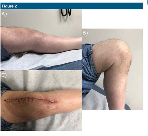 Figure 2 from Enterobacter cloacae Periprosthetic Joint Infection After Bariatric Surgical ...