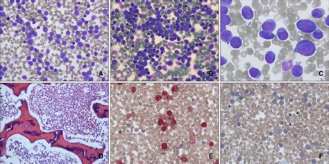 (A) Peripheral blood smear showing markedly elevated monoblast and... | Download Scientific Diagram