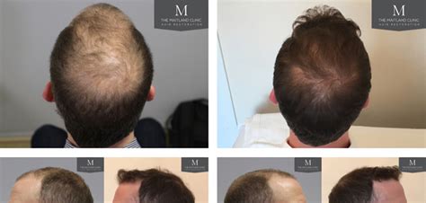 FUT Hair Transplant Before After Photos and Results