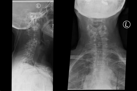 Rheumatoid Arthritis X Ray Neck