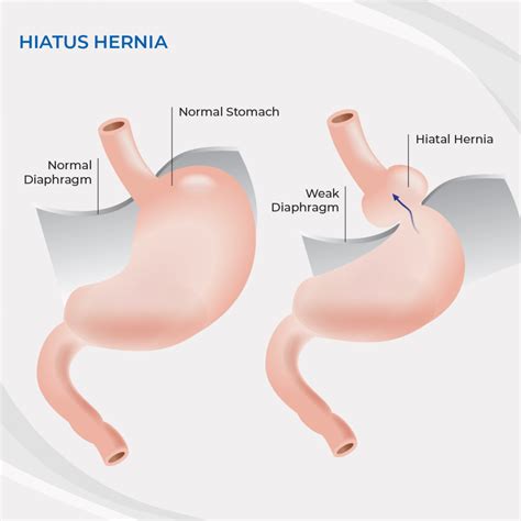 Hiatus Hernia Surgery Central Coast (Gosford & Tuggerah) | Dr Peter Hamer