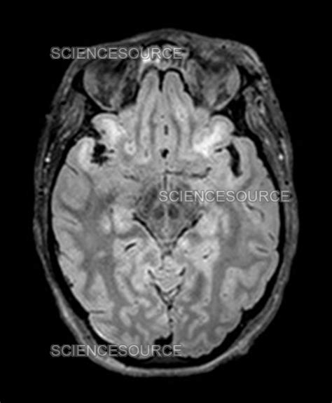 Photograph | Severe Traumatic Brain Injury, MRI | Science Source Images