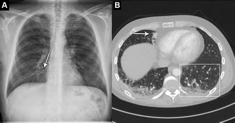 Artificial Intelligence 'Can Help Spot Early Signs of Cancer in Chest X-Rays'