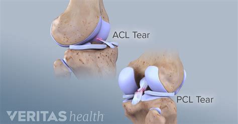 Symptoms of Posterior Cruciate Ligament (PCL) Tears