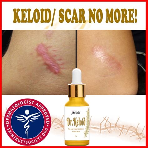 Keloid Scar Treatment Aspirin at Jesse Bowlin blog