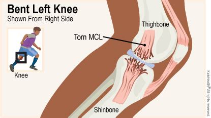 Medial Collateral Ligament (MCL) Injuries (for Parents) - Seattle Children's Hospital