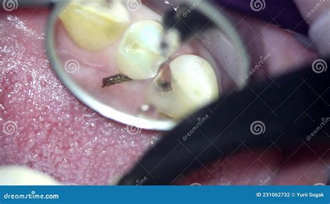 Dentistry. Video Filming Under a Microscope Stock Footage - Video of ...