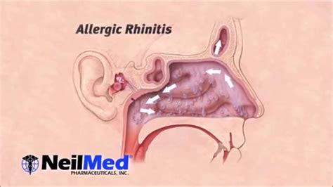 Sinus Rinse Diagram