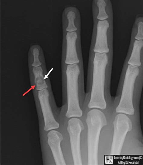 LearningRadiology- Enchondroma