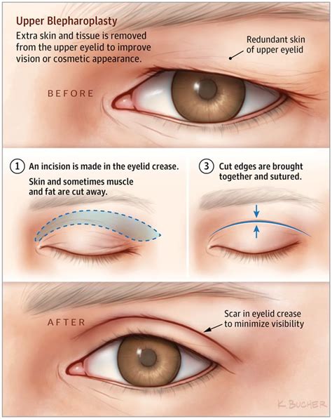 Upper Blepharoplasty | Eye lift surgery, Face lift surgery, Facial plastic surgery