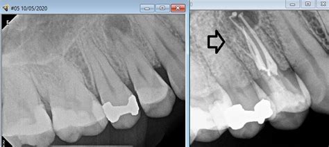 Root canal anatomy maxillary premolar - How many canals?