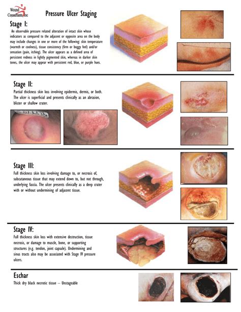 Stage I - WoundConsultant.com