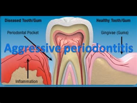 Aggressive periodontitis - YouTube