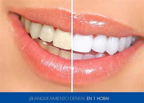 BLANQUEAMIENTO DENTAL PUEBLA 磊